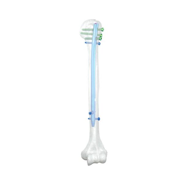 Clavo Humeral Universal