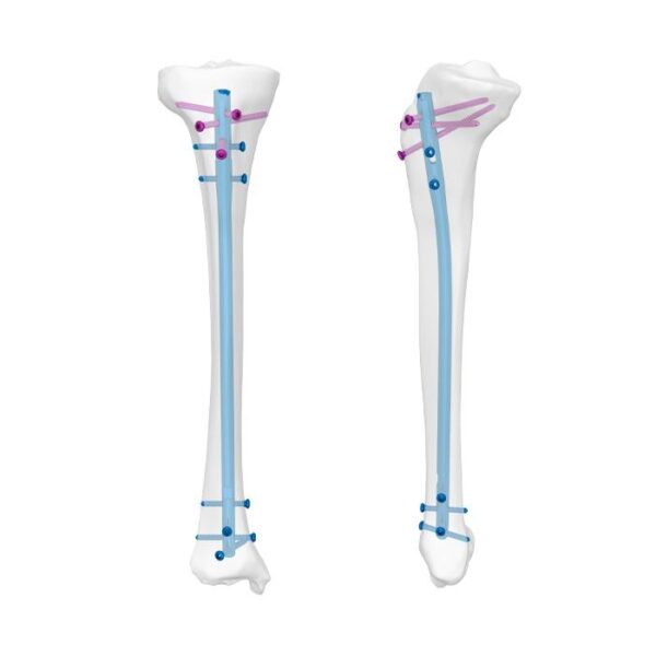 Clavo Tibial Universal Ⅱ