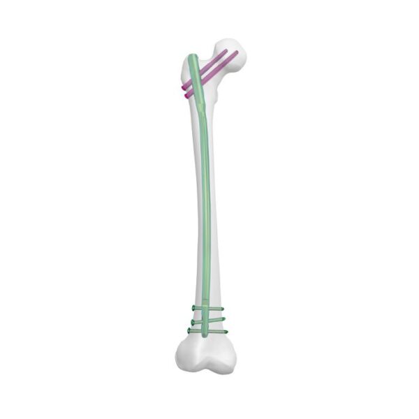Clavo Femoral Universal Ⅱ