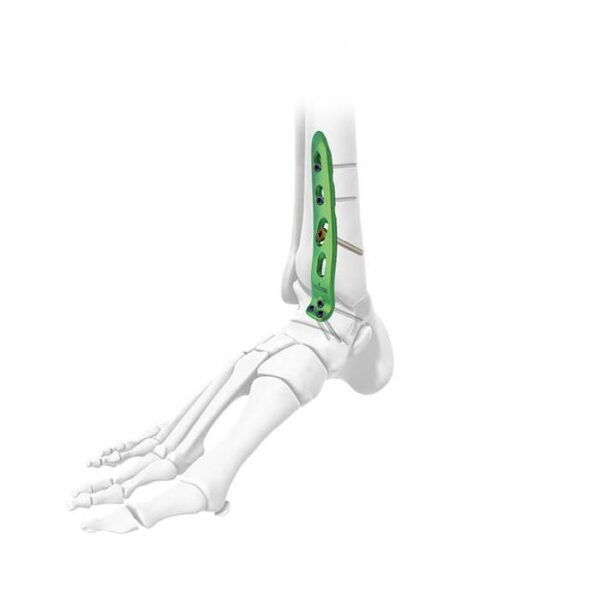 Placa de bloqueo para fusión de tobillo