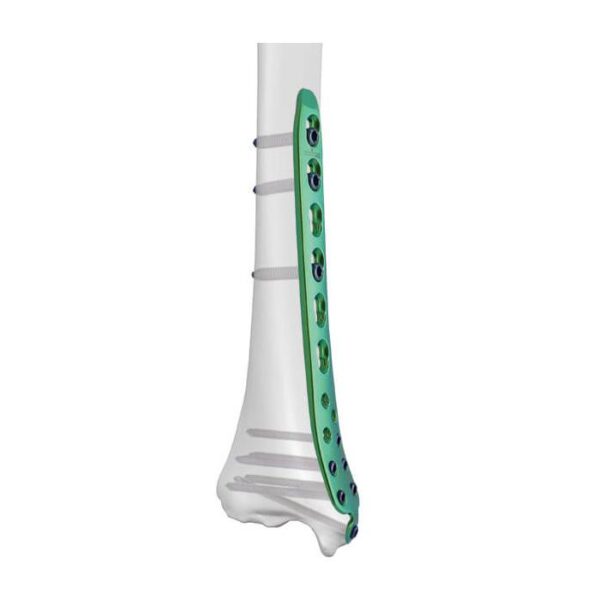 Placa Bloqueada Tibial Distal Medial