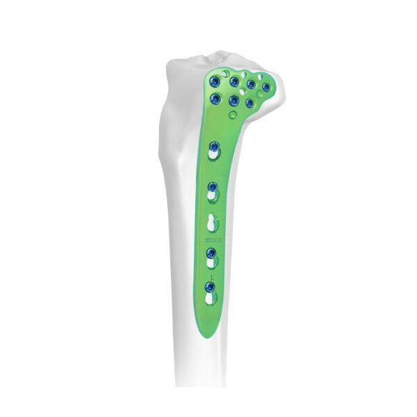 Placa Bloqueada Tibial Proximal Lateral