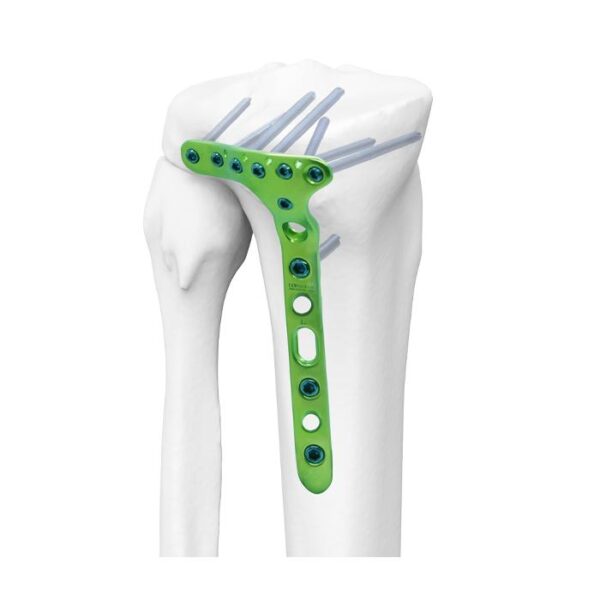 NOVEL Placa Bloqueada Tibial Proximal Posterior