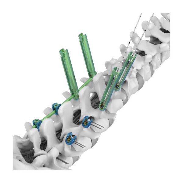 Sistema de Columna Lumbar Mínimamente Invasiva TINA MIS