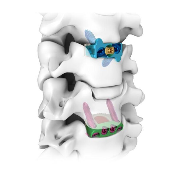 Caja Bloqueada Intervertebral Cervical Anterior