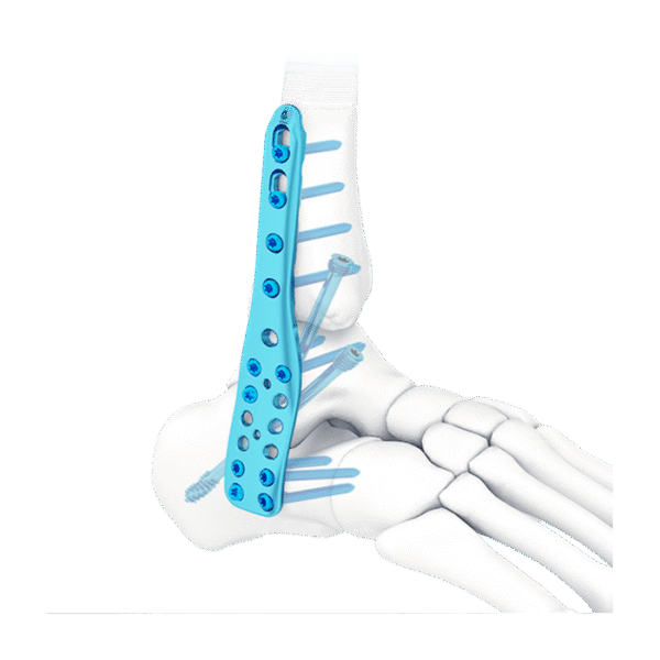 Placa de bloqueo para artrodesis lateral de tobillo