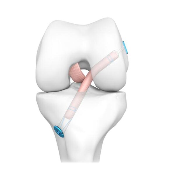 Solución de reconstrucción de LCA / LCP para la fijación tibial