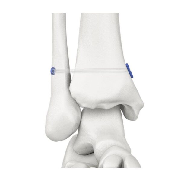 Sindesmosis sin nudos CF Botón de bucle