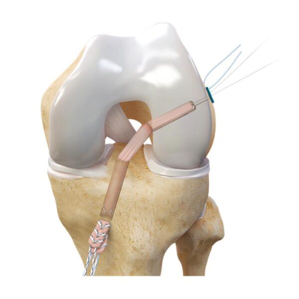 Botón ajustable CFLoop