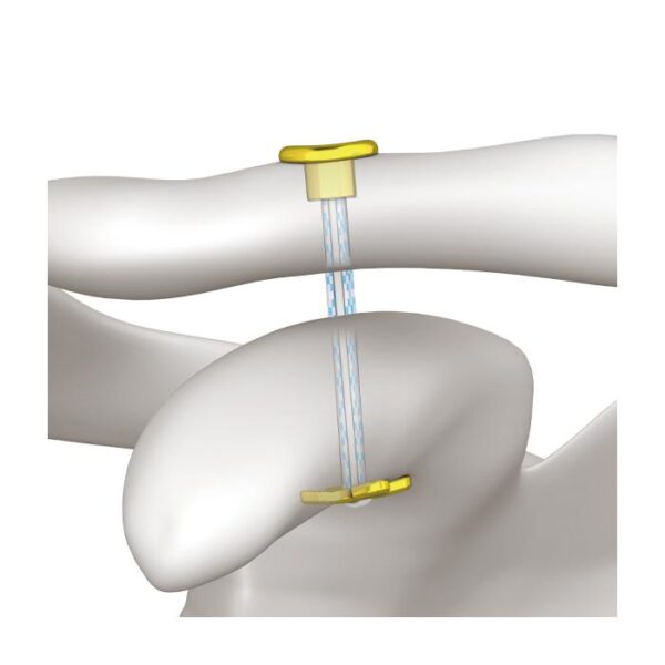 Sistema de botón ajustable AC cfloop