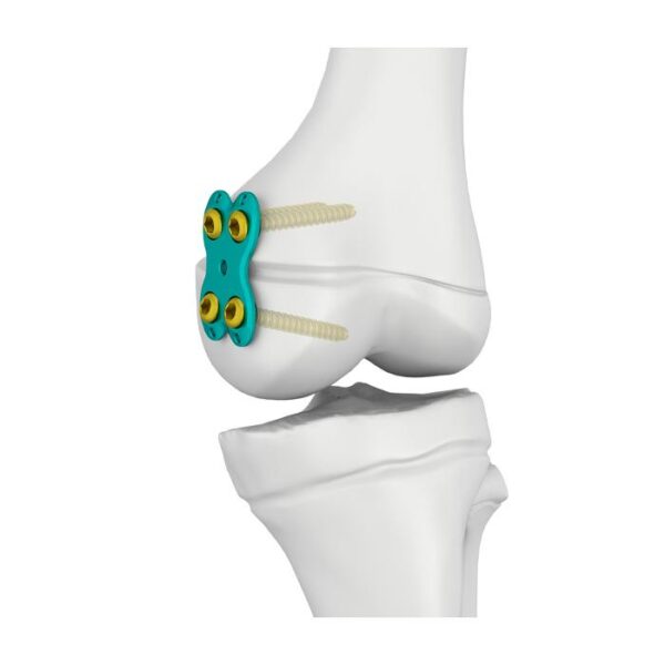 Placa epifisaria de 4.5 mm, en forma de mariposa