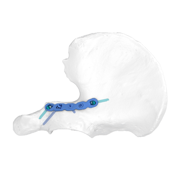 Placa de bloqueo anatómica para columna posterior FAP