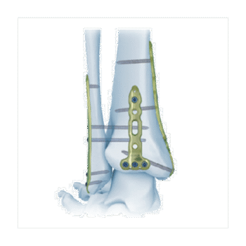 Placa de bloqueo Tibial Distal Tibial MD