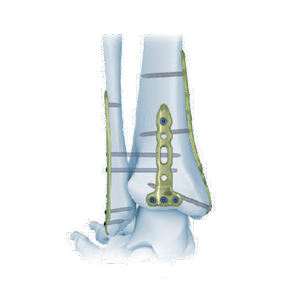 Placa de bloqueo Tibial Distal Tibial MD