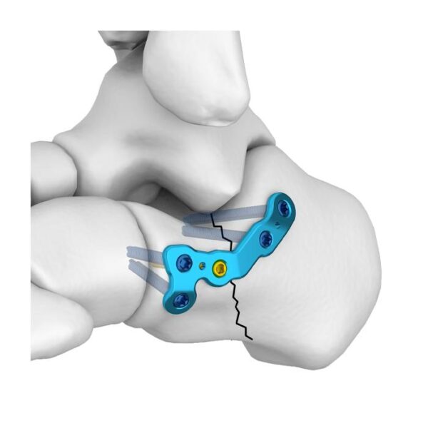 MT Placa Bloqueada Calcaneal de Proceso Anterior