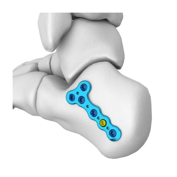 MT Placa Bloqueada Calcaneal de Tuberosidad Posterior
