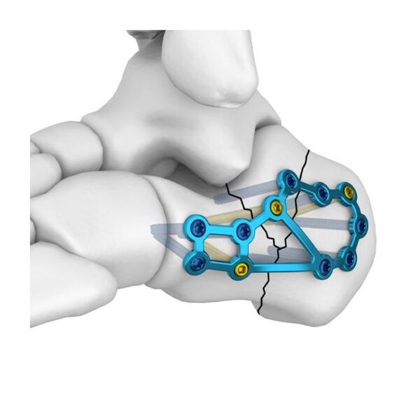 MT Placa Bloqueada Calcaneal