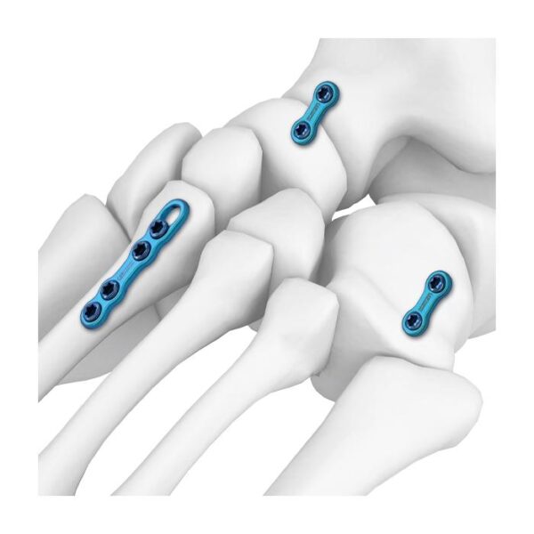 Placa de bloqueo de fusión recta MT