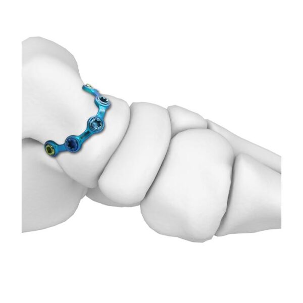 Placa de bloqueo MT Talus