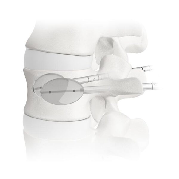 Sistema de vertebroplastia percutánea PVP