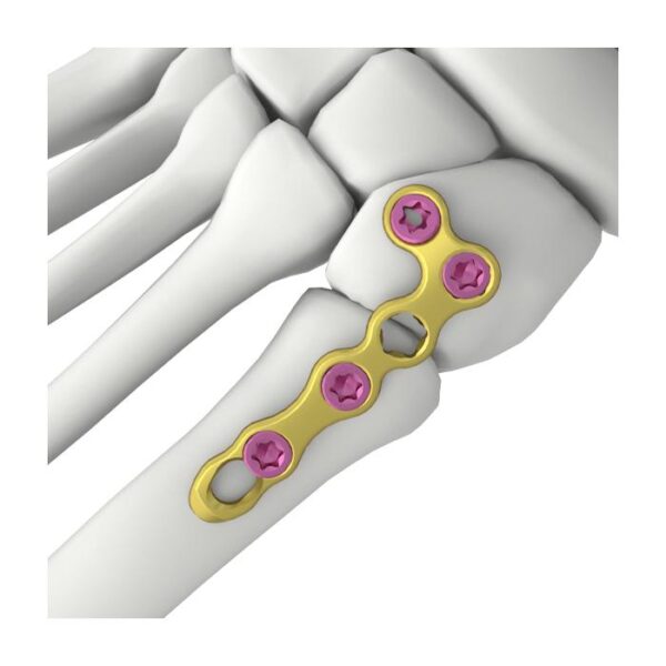 Placa de bloqueo itval en forma de l