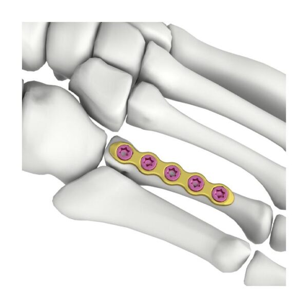 Placa de bloqueo recta itval