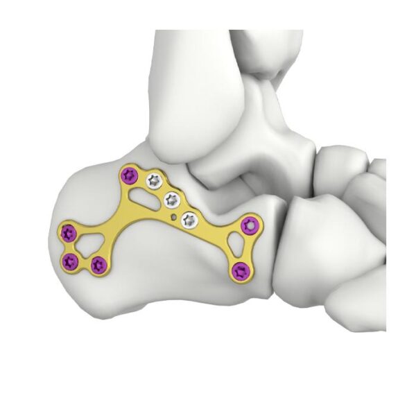 Placa de bloqueo MIS para calcáneo itval