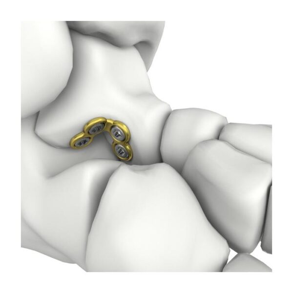 Placa de bloqueo de astrágalo itval