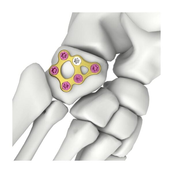 Placa de bloqueo paralelepípedo itval