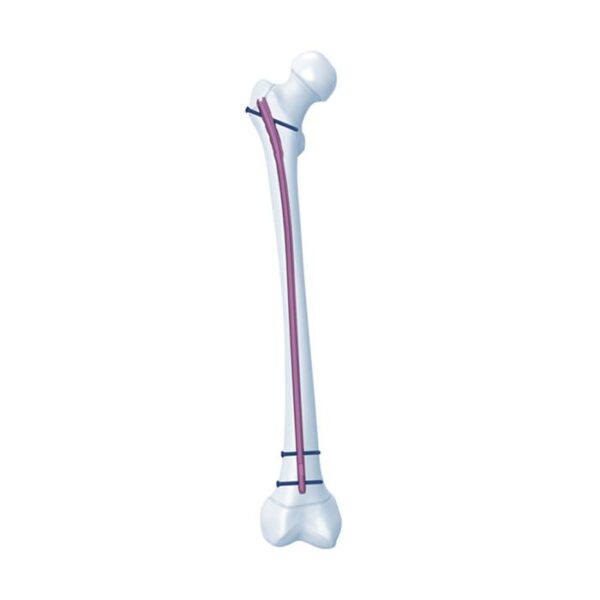 Sistema de clavos femorales para adolescentes