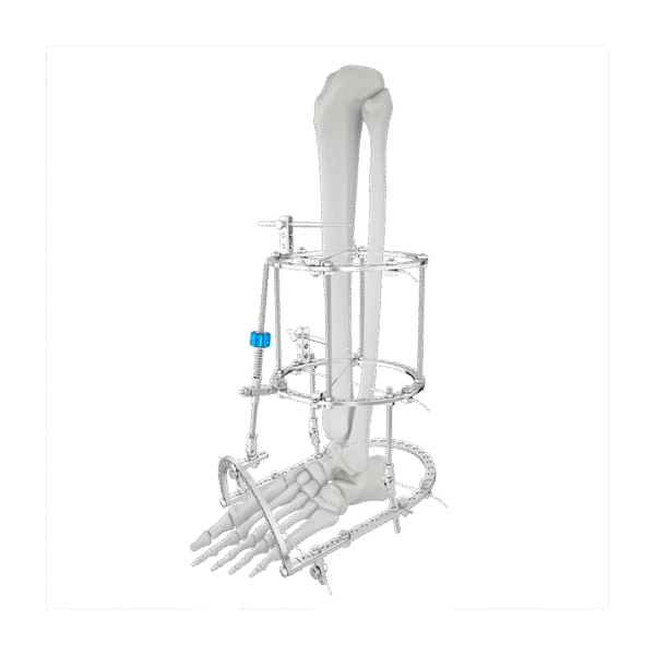 Fijador Externo Redondo Ilizarov