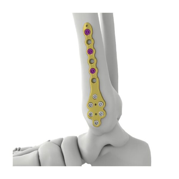 Placa de bloqueo tibial distal medial itval