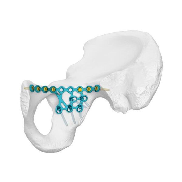 Placa de bloqueo de línea infraarqueada de columna posterior alta