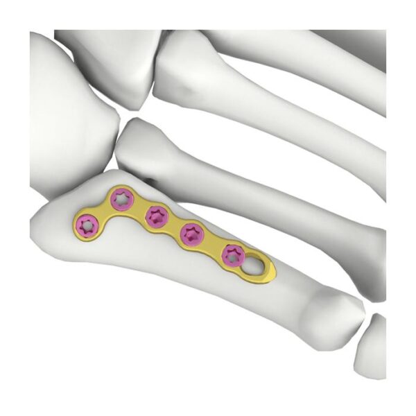 Placa de bloqueo en forma de L oblicua itval