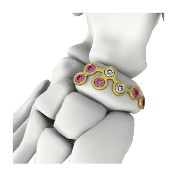 Placa de bloqueo navicular itval