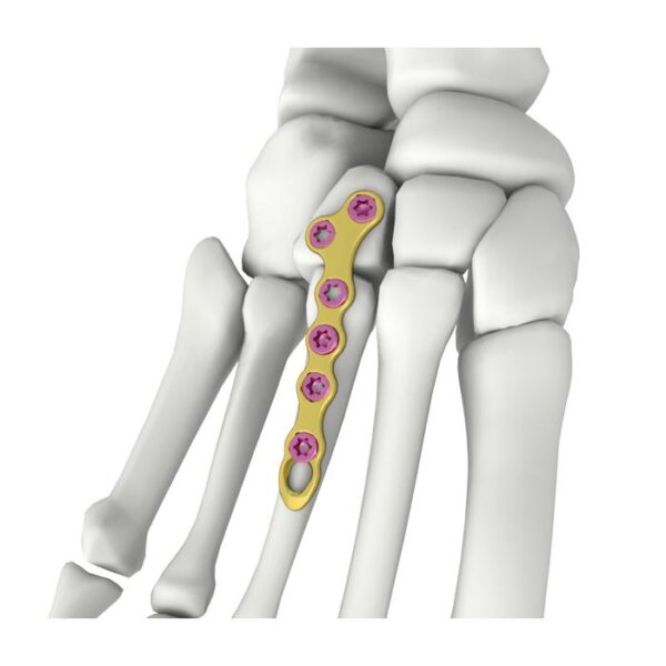 Placa de bloqueo en forma de T oblicua itval