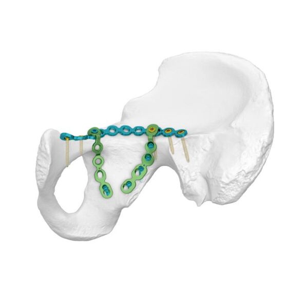 Placa de bloqueo de línea supraarqueada