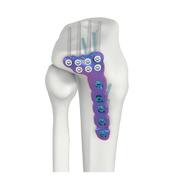 Placa de bloqueo DR tibial lateral proximal VAL