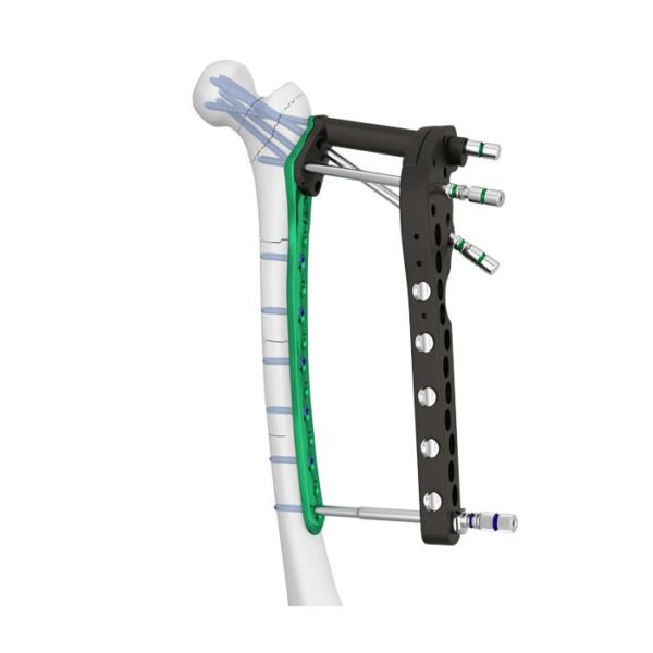 Placa Bloqueada Femoral Proximal Ⅲ