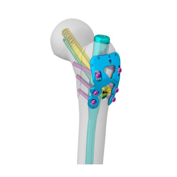 Trocánter mayor N Placa