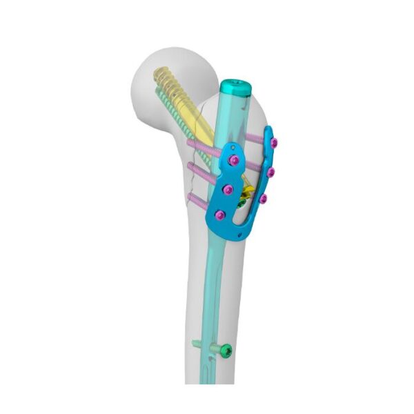 Placa en U del trocánter mayor