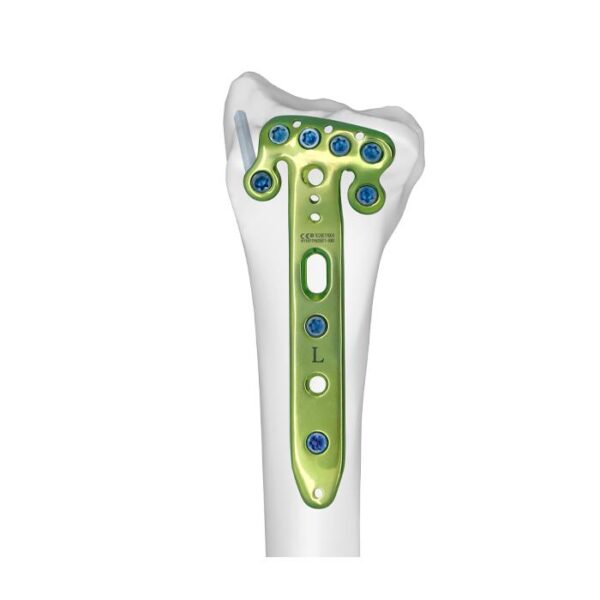 Placa Bloqueada de Radio Distal Volar