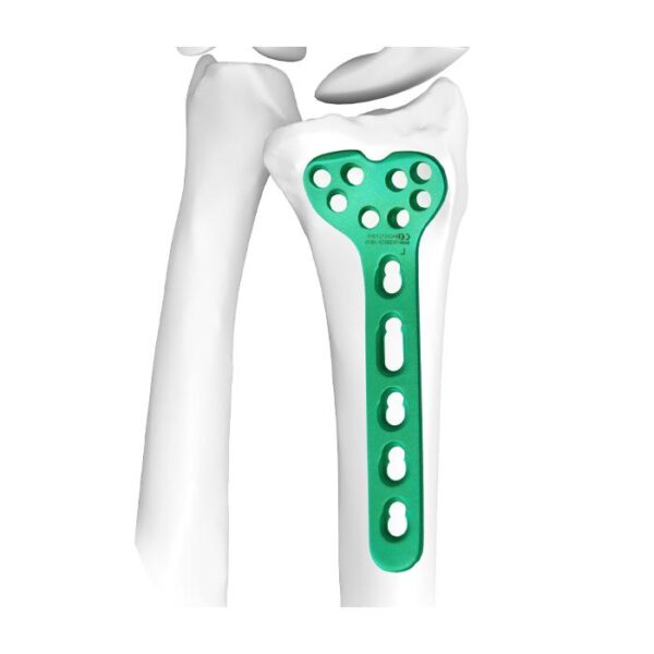 Placa Bloqueada de Radio Distal Ⅱ