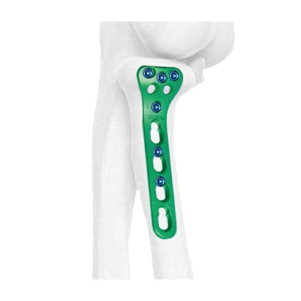 Placa Bloqueada de Radio Proximal