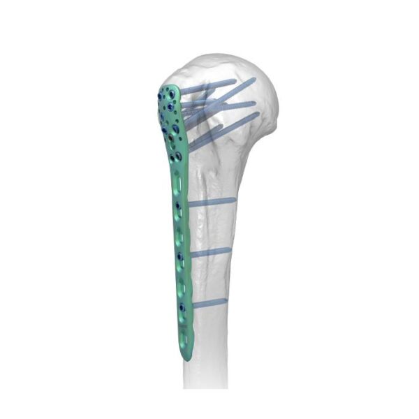 Placa Bloqueada Humeral Proximal Ⅱ