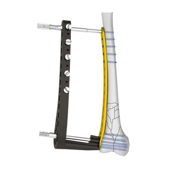 Placa Bloqueada Femoral Distal Ⅱ