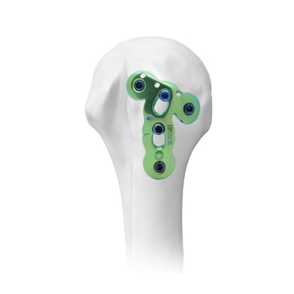 Placa Bloqueada Humeral Proximal para Gran Tuberosidad