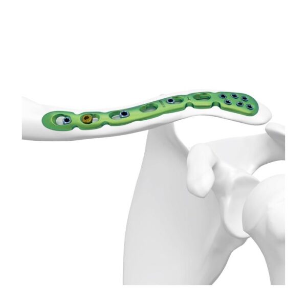 Placa Bloqueada Clavicular Distal Superior Anterior