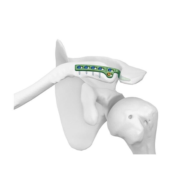 Placa Bloqueada Clavicular con Gancho Ⅲ
