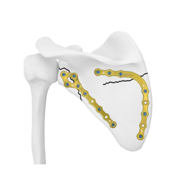 Placa de bloqueo medial de la escápula
